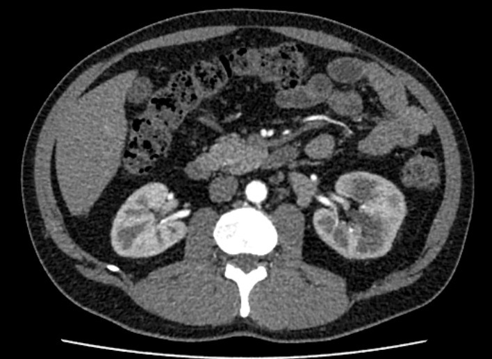 Computertomographie axiales Schnittbild der Nieren